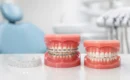 Tipuri de aparat dentar: ce alegi corect