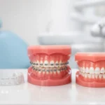 Tipuri de aparat dentar: ce alegi corect